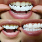 Facettes Dentaires Artificielles